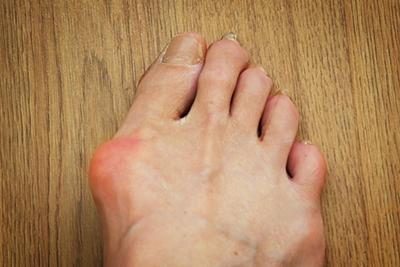 Common Myths About Bunions Debunked