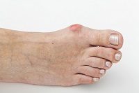 What Can I Do About Bunions?