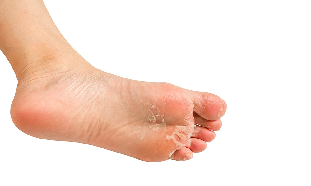 Athlete's Foot
