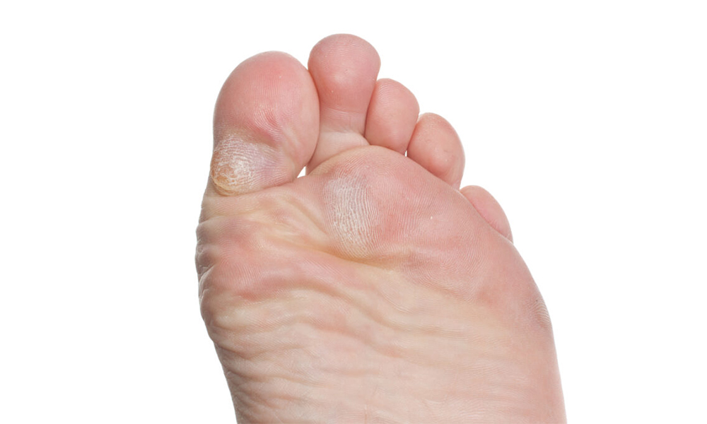 Corns & Calluses