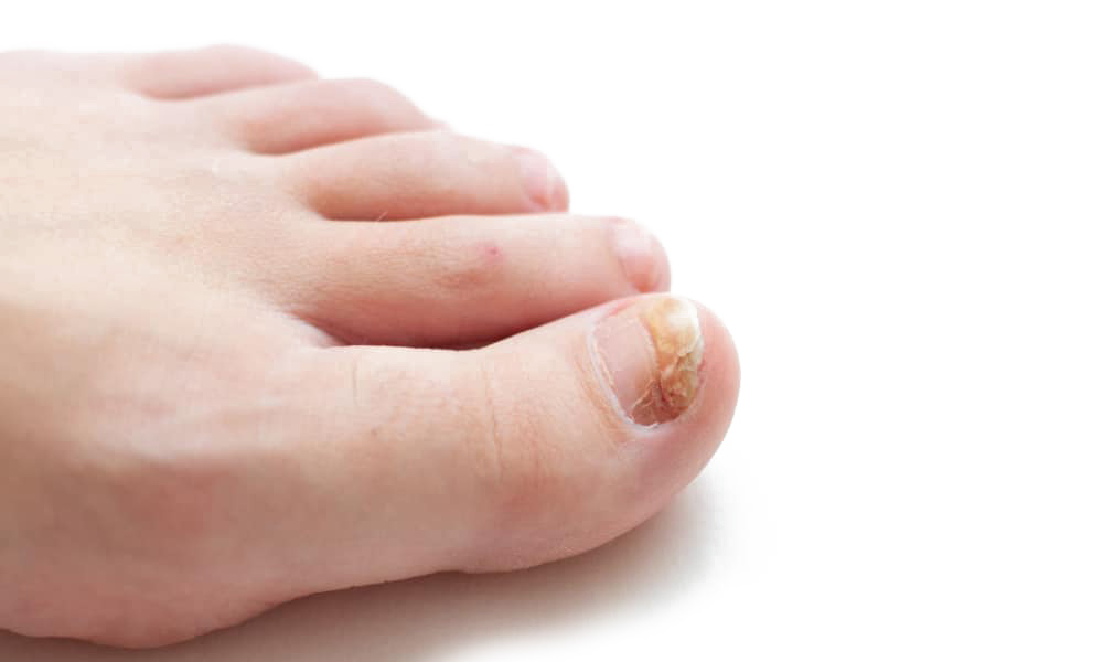 Fungal Toenails